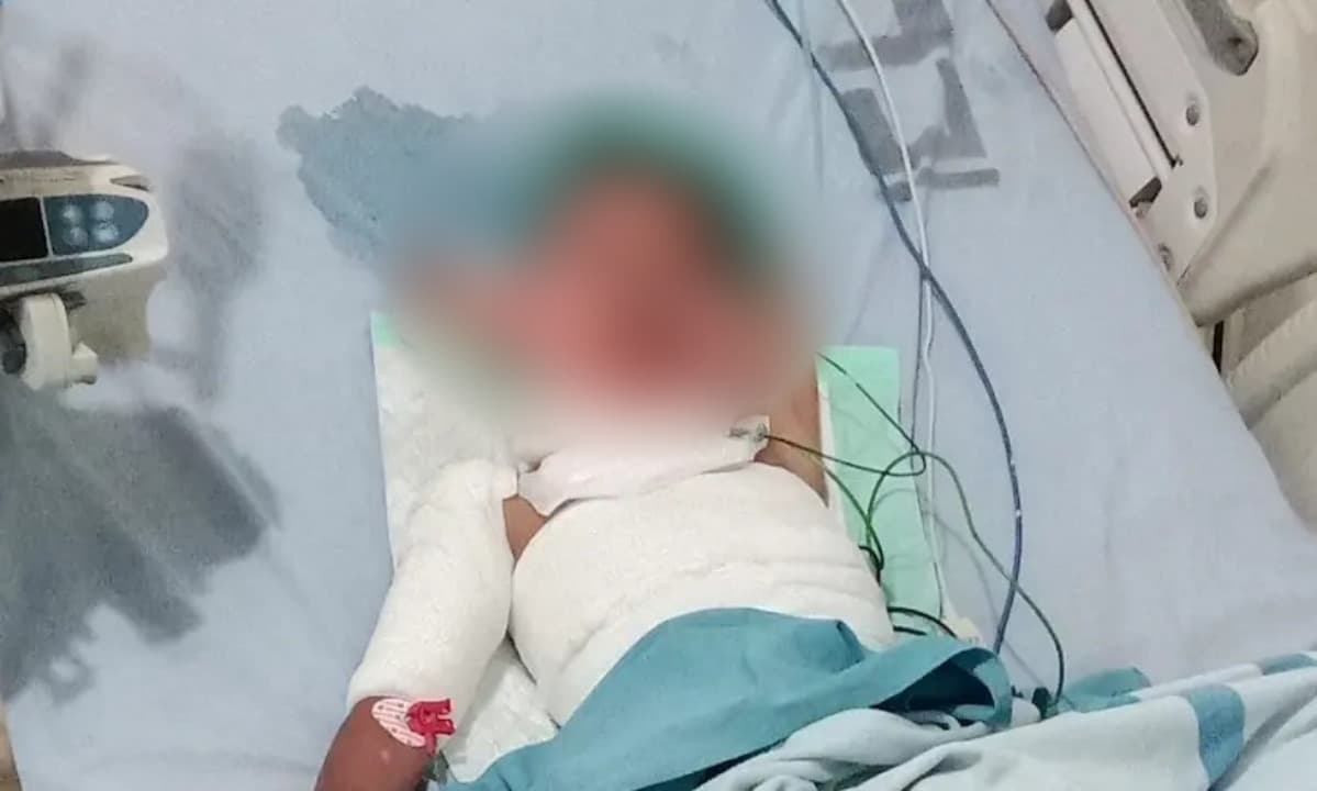 Terkena Spirtus, Bocah 10 Tahun di Situbondo Alami Luka Bakar