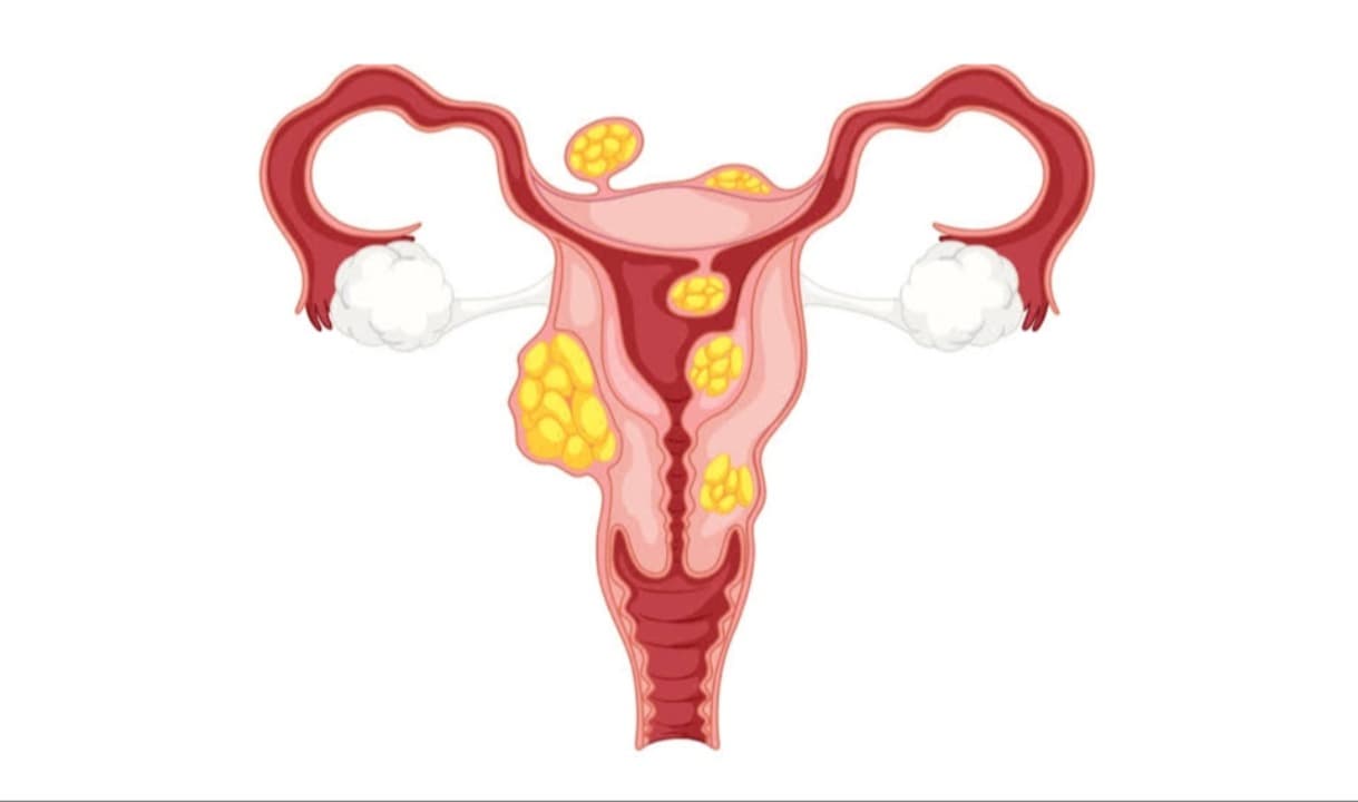 Myoma Uteri Problema Utama Bagi Wanita