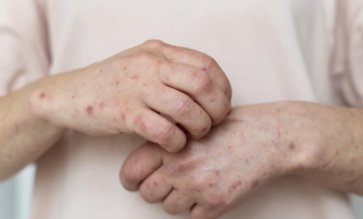 Indonesia Darurat Campak: Penularan Lebih Cepat dari Covid-19, Waspada Risiko Fatal pada Anak